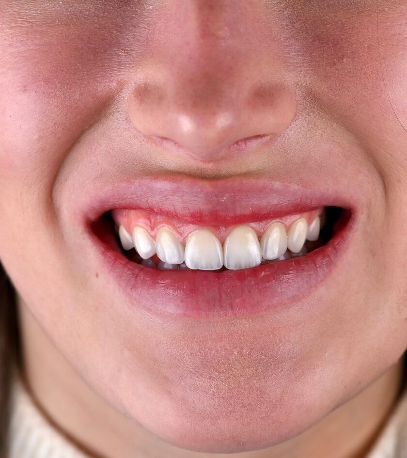 Pēc ārstēšanas: 8 non-prep venīri bez zobu slīpēšanas