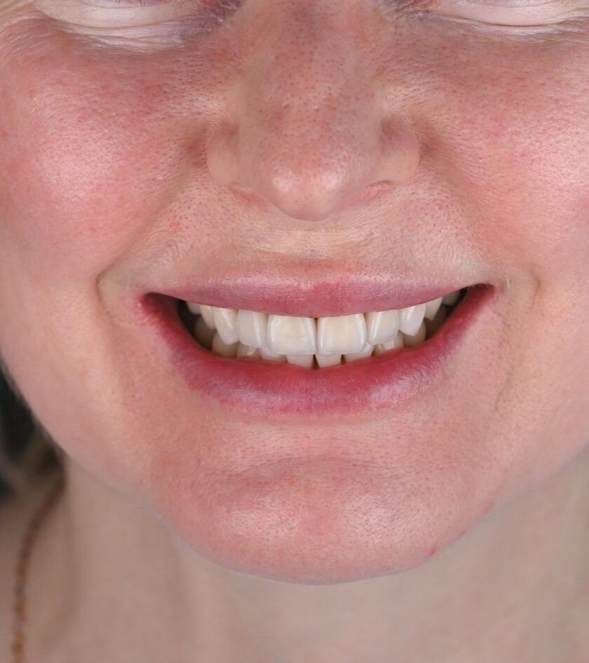 Pēc ārstēšanas: 6 priekšējo zobu estētika