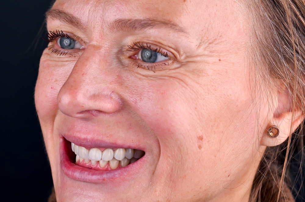 Pēc ārstēšanas: pēc metālkeramikas kroņiem
