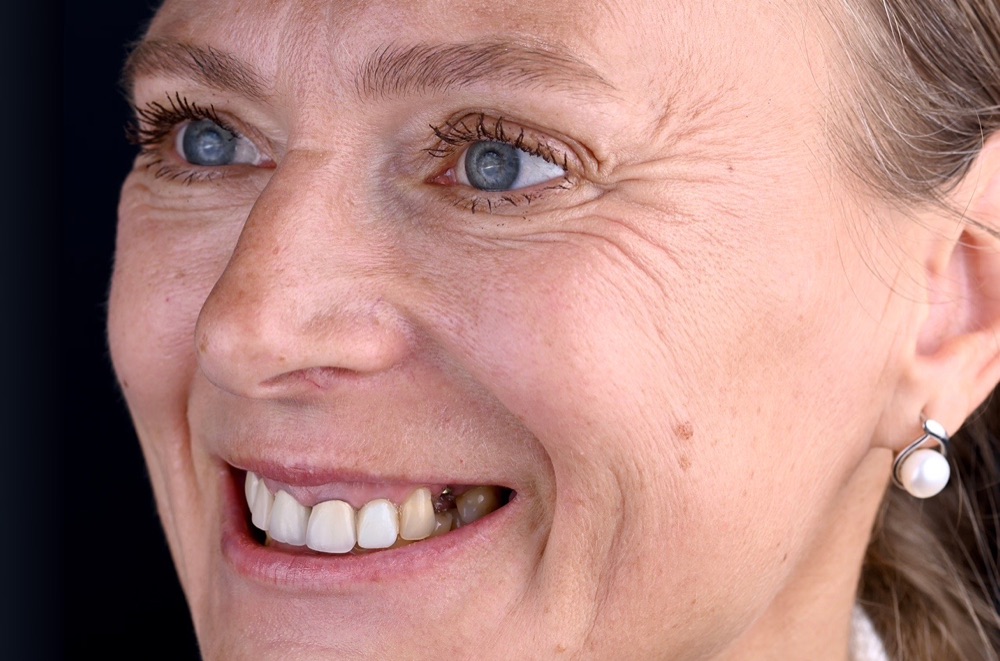 Pirms ārstēšanas: pēc metālkeramikas kroņiem